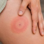 Rumień po kleszczu jak wygląda dzień po dniu? Sprawdź różnice wobec podrażnienia, tempo wzrostu zmiany oraz objawy, przy których potrzebna jest szybka konsultacja z lekarzem POZ.