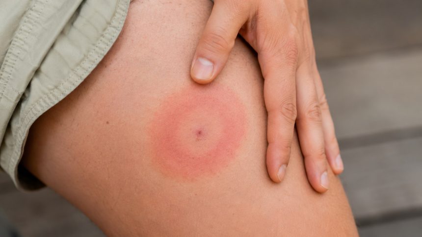 Rumień po kleszczu jak wygląda dzień po dniu? Sprawdź różnice wobec podrażnienia, tempo wzrostu zmiany oraz objawy, przy których potrzebna jest szybka konsultacja z lekarzem POZ.