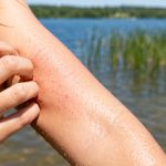 Swędzenie skóry po kąpieli w jeziorze może wywołać kontakt z cerkariami, sinicami lub zanieczyszczoną wodą. Sprawdź objawy, sposoby łagodzenia świądu i sygnały wymagające konsultacji.