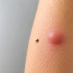 Po ukąszeniu meszki często pojawia się twardy, swędzący obrzęk. Wyjaśniamy, dlaczego reakcja trwa kilka dni, jak łagodzić objawy i które symptomy wymagają pilnej konsultacji z lekarzem lub pogotowia.