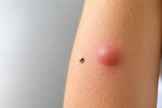 Po ukąszeniu meszki często pojawia się twardy, swędzący obrzęk. Wyjaśniamy, dlaczego reakcja trwa kilka dni, jak łagodzić objawy i które symptomy wymagają pilnej konsultacji z lekarzem lub pogotowia.