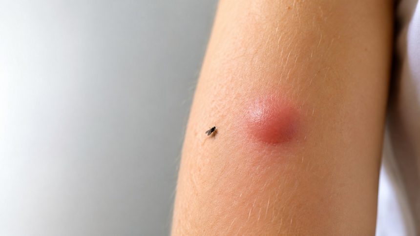 Po ukąszeniu meszki często pojawia się twardy, swędzący obrzęk. Wyjaśniamy, dlaczego reakcja trwa kilka dni, jak łagodzić objawy i które symptomy wymagają pilnej konsultacji z lekarzem lub pogotowia.